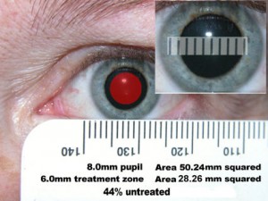 lasikpupil-300x225