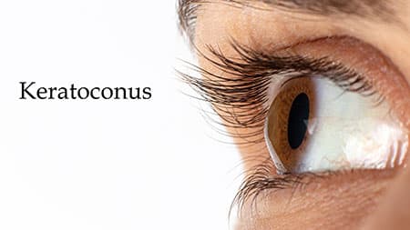 Corneal Collagen Cross-Linking for Keratoconus in Smithfield